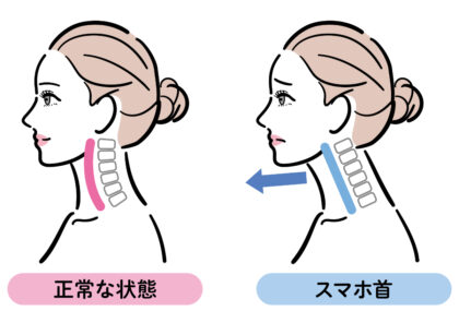 首が痛いときの主な原因・・・ストレートネック（スマホ首）